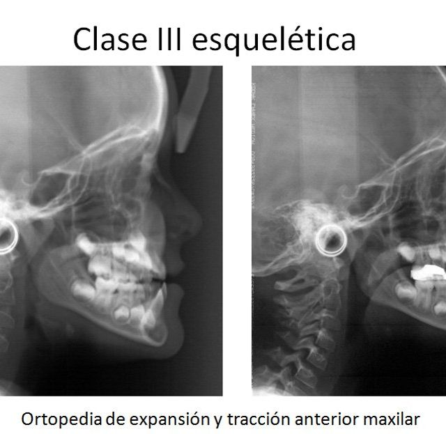 Ortodoncia Carlton expansión y tracción